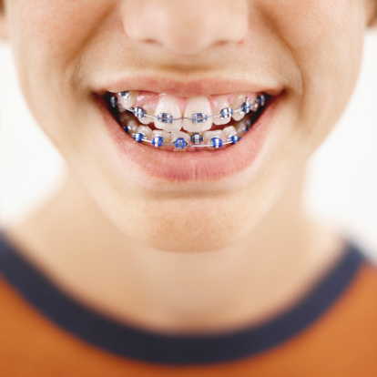 Ortodonti Nedir